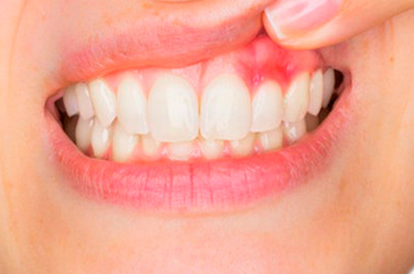 How Proper Brushing Can Prevent Gum Disease?